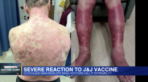 J&J製ワクチンを接種した男性の皮膚が真っ赤に腫れ表皮剥離の副反応——ドイツ政府はアストラゼネカ製ワクチンを60歳未満に投与することを制限
